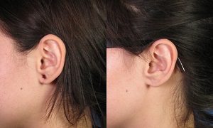 Ear Lobe Repair