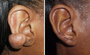Removal of Keloids