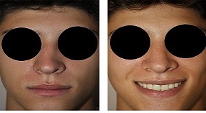 Rhinoplasty