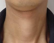 Thyroid disorder in Pune